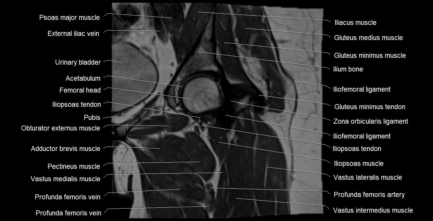 MRI Hip 3T coronal cross sectional anatomy image 26.webp